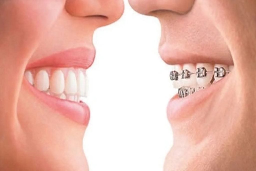 Smiling faces side by side, one with clear aligners and the other with metal braces, illustrating the comparison between orthodontic treatment options.